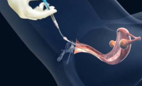 双方地贫做第三代试管婴儿要花多少钱？